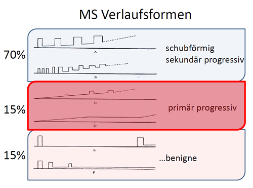 Multiple Sklerose: Verlaufsformen