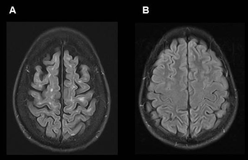 MRT-Aufnahmen des Gehirns eines MS-Patienten (A) und einer Kontrollperson (B), zur Veranschaulichung, wie sich die Erkrankung im Gehirn manifestiert: In (A) sichtbar die für die MS typischen weißen Läsionen nahe der Großhirnrinde sowie der Schwund (Atrophie) des Gehirns. Foto: Achim Gass (UMM)